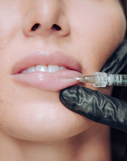 Close-up of a woman’s lips receiving a lip filler injection from a professional wearing black gloves.