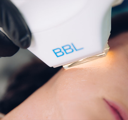 A close-up of a BBL laser being used on a person's skin.