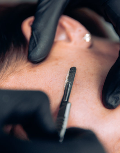 A close-up of gloved hands using a blade to gently exfoliate the skin on a person's face.